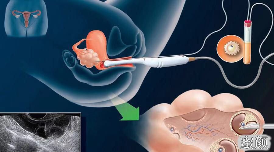 陕西供卵借卵试管婴儿有补贴吗，生育保险可以报销吗？