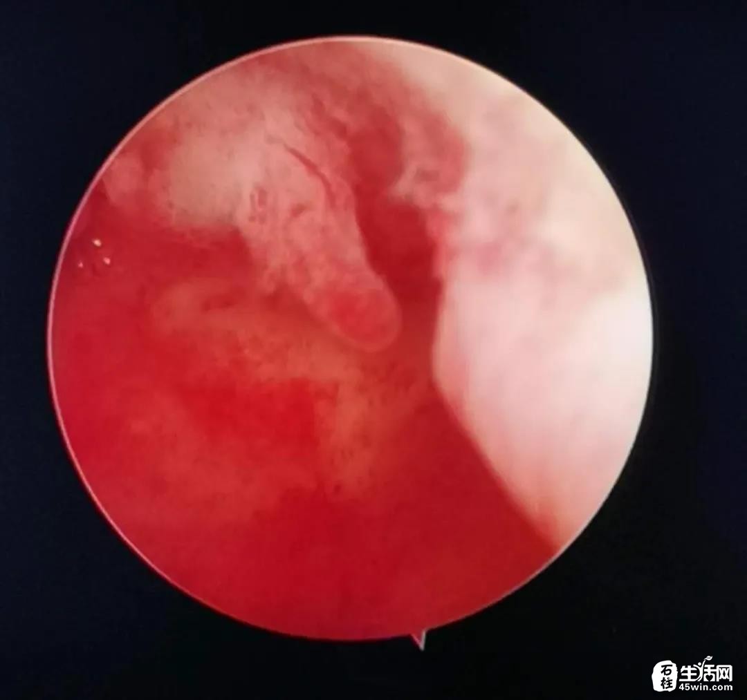 做供卵公立代怀试管怀孕后怎么防止胎停